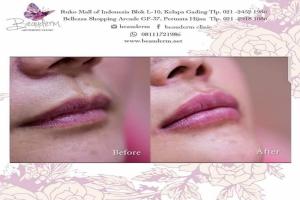 Lips Filler / Filler Bibir
